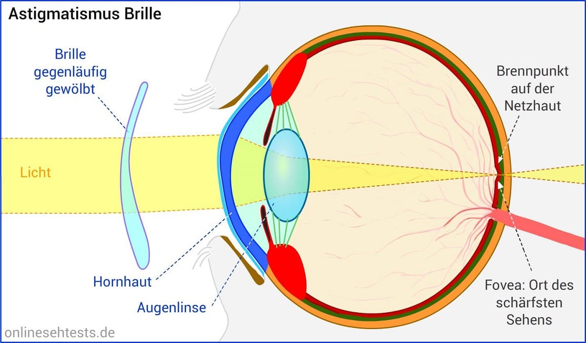 Graphik zeigt wie eine Brille mit Zylinder einen Astigmatismus oder Hornhautverkrümmung korrigiert. Blog von Optiker Gronde