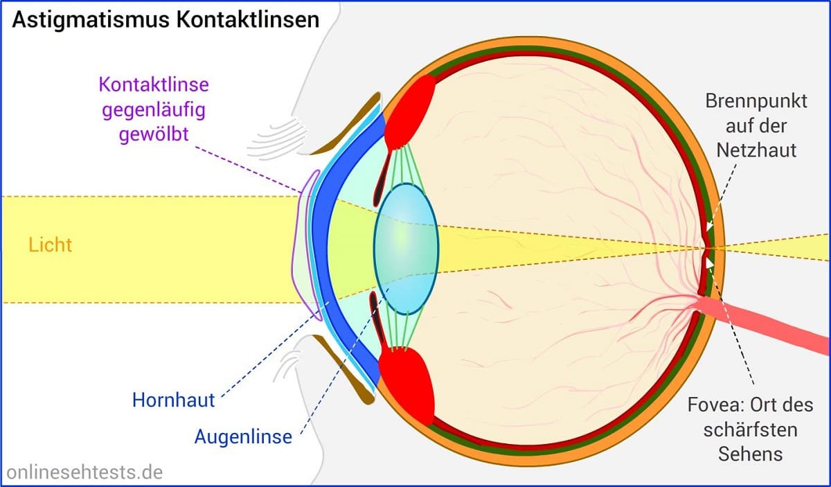 Graphik zeigt wie torische Kontaktlinsen Astigmatismus oder Hornhautverkrümmung korrigieren. Im Blog von Optiker Gronde