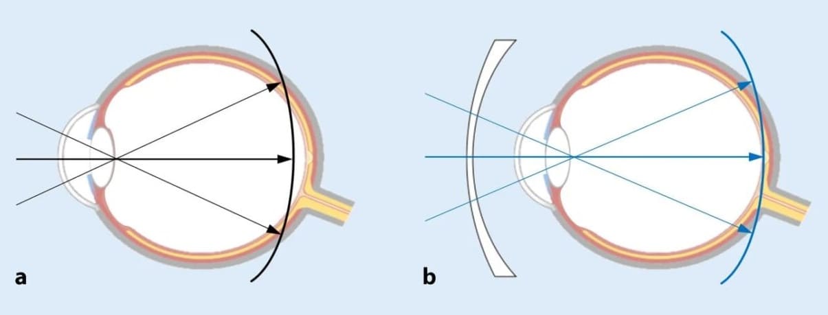 Schaubild Randunschärfen bei Kurzsichtigkeit - hyperoper Defokus. Optiker Gronde