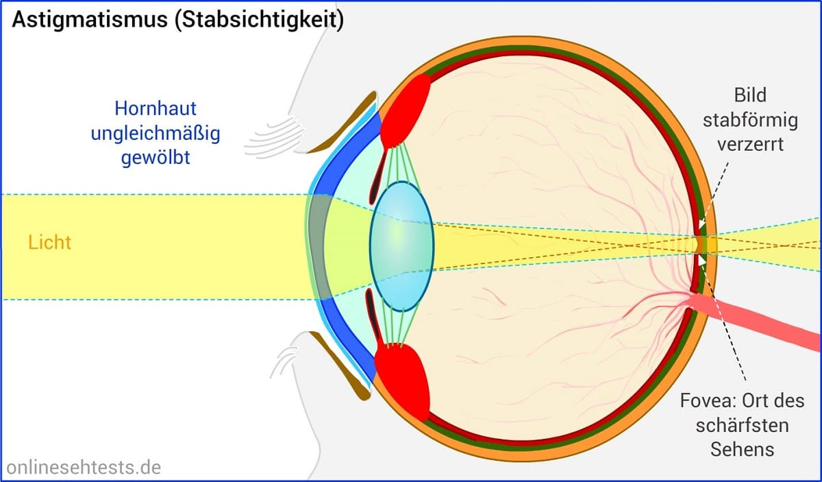 Graphik Auge mit Astigmatismus beziehungsweise Hornhautverkrümmung im Blog von Optiker Gronde