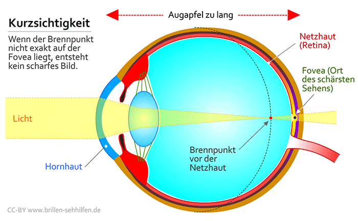Kurzsichtigkeit erklärt am menschlichen Auge. Optiker Gronde