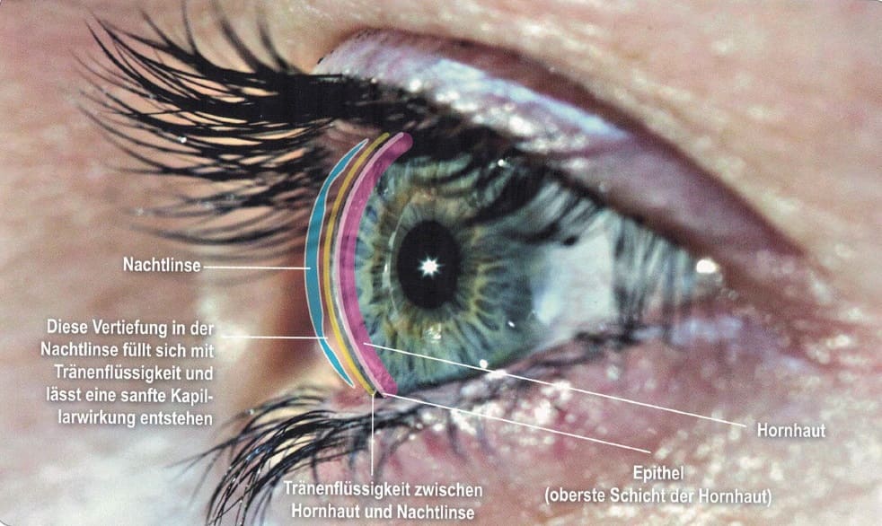 Schaubild Auge erklärt  wie Nachtlinsen oder Ortho-K-Linsen funktionieren. Optiker Gronde